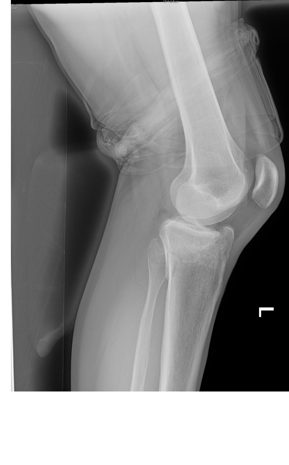 Lateral left knee X-ray for the hyperextension injury scenario.