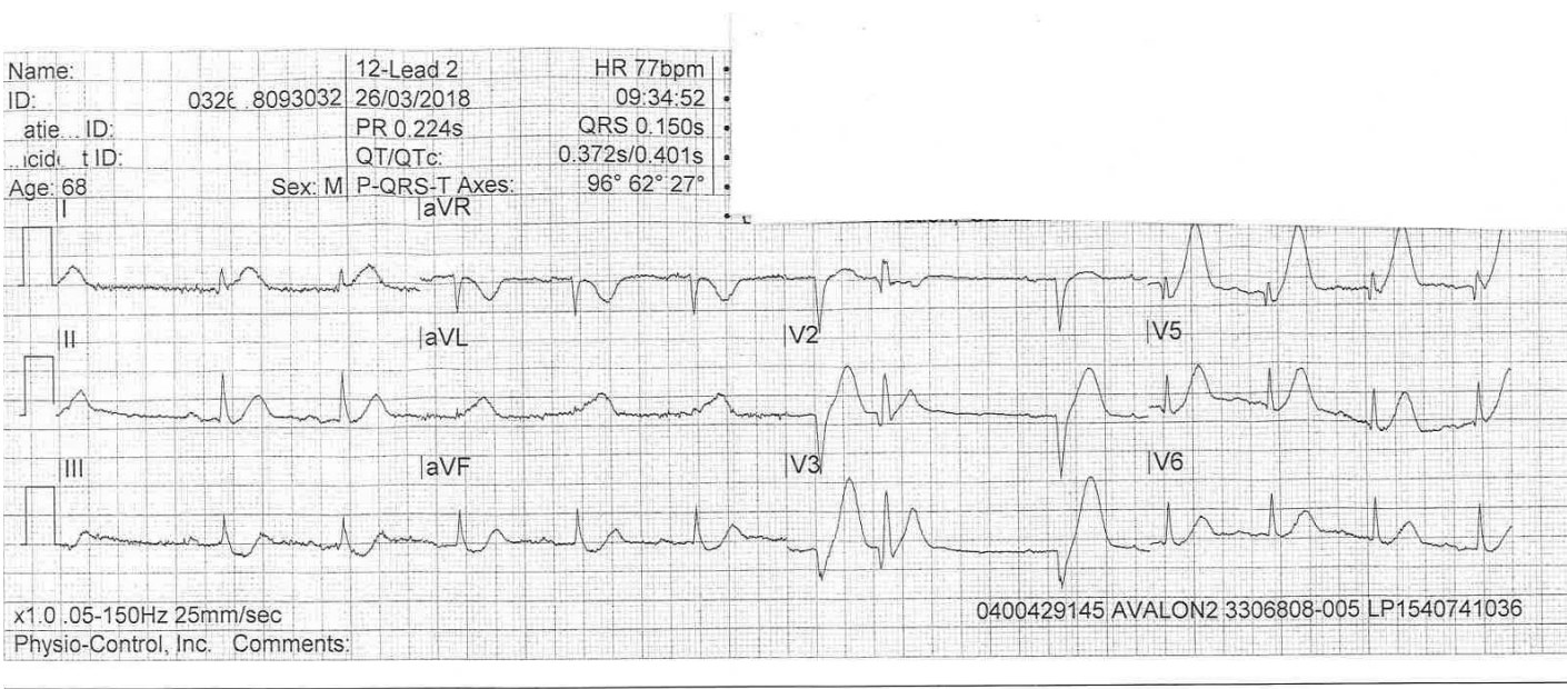 Ambulance-transmitted 12-lead ECG for a 45-year-old man with central chest pain.