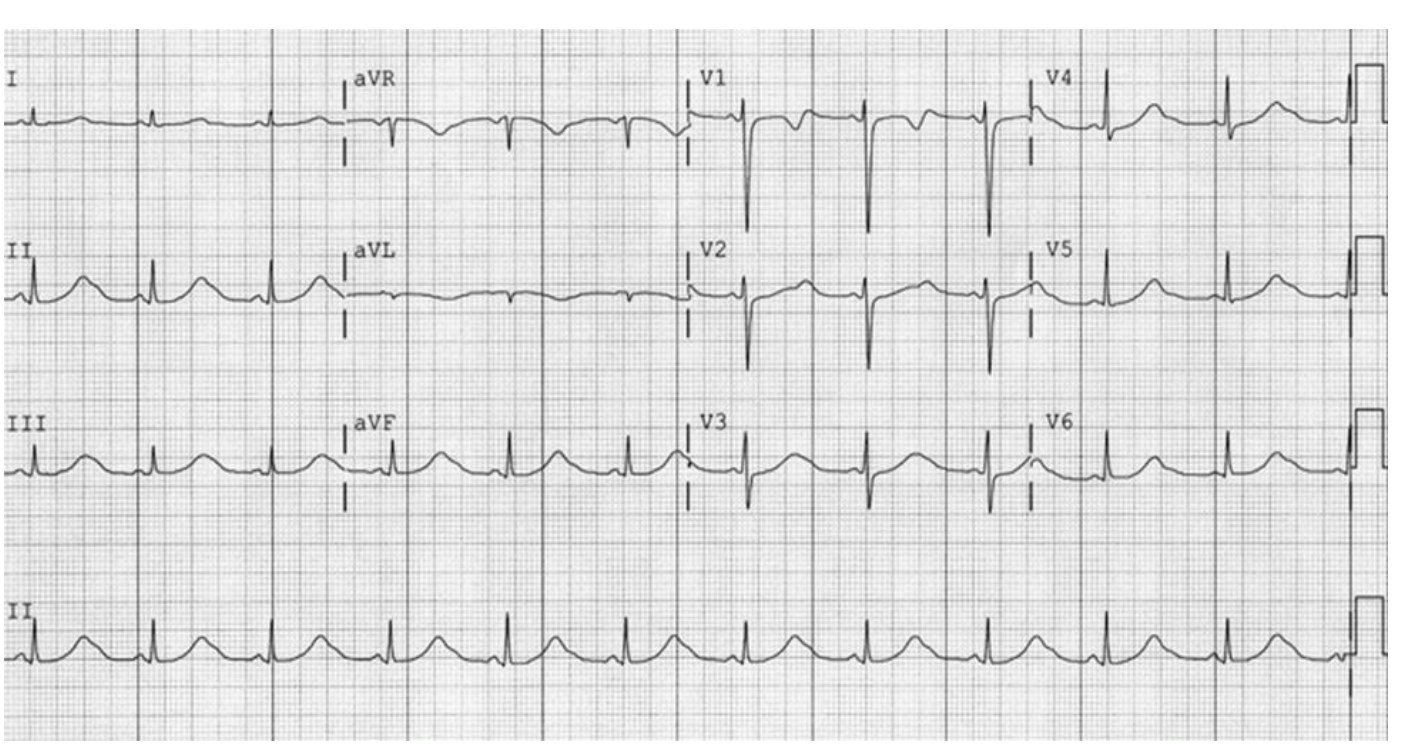 12-lead ECG for a young woman presenting with syncope.