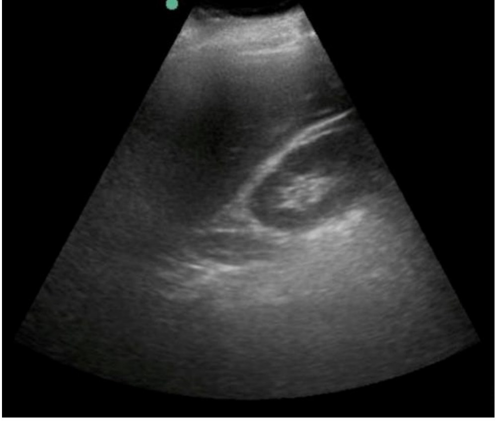 Right upper quadrant FAST ultrasound image in a stable blunt trauma patient.