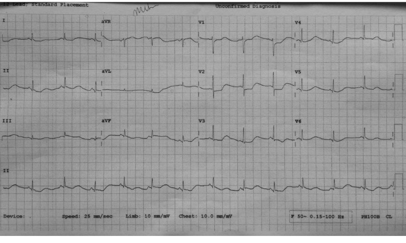 12-lead ECG in a developmentally delayed patient presenting with vomiting.