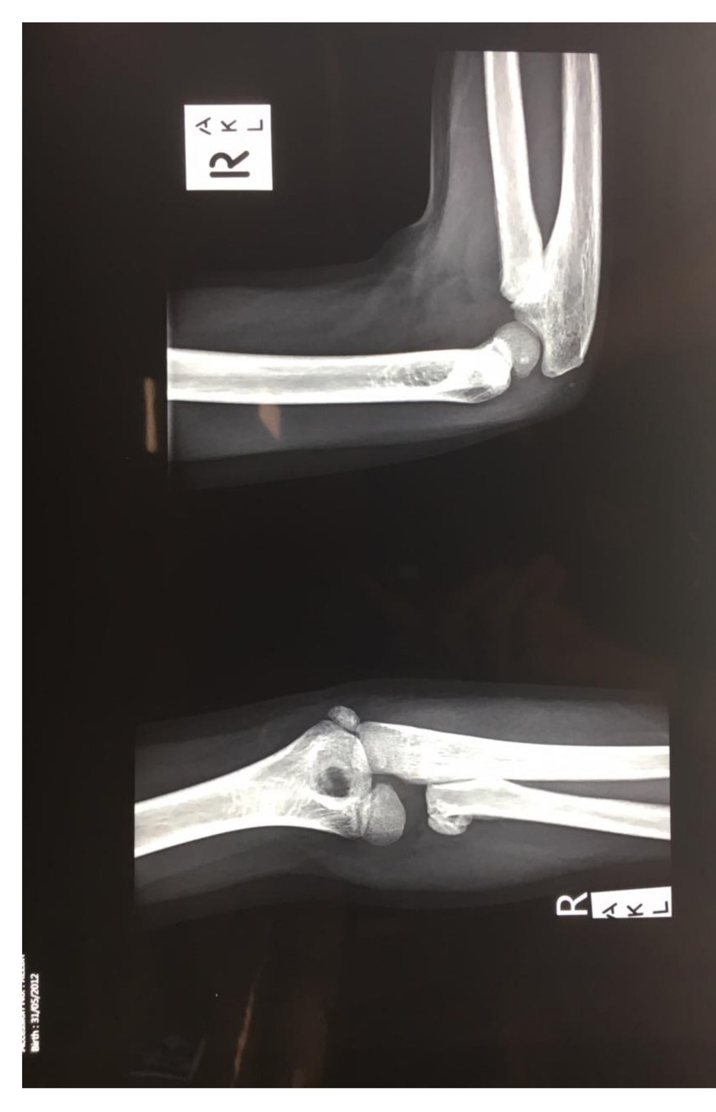 AP and lateral right elbow x-rays in a child returning with missed injury.