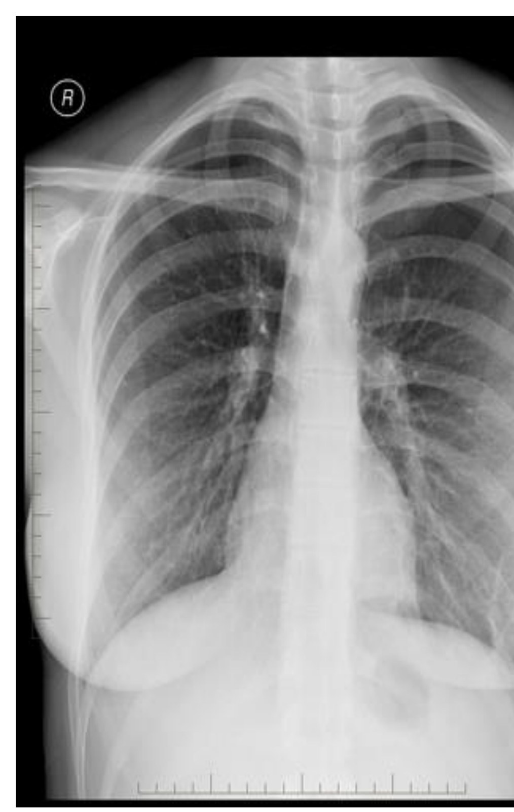 PA chest x-ray in a woman with chest discomfort and exertional dyspnoea.