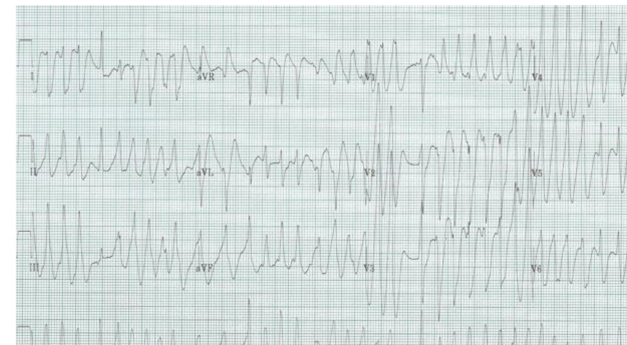 12-lead ECG in a woman with palpitations and light-headedness.