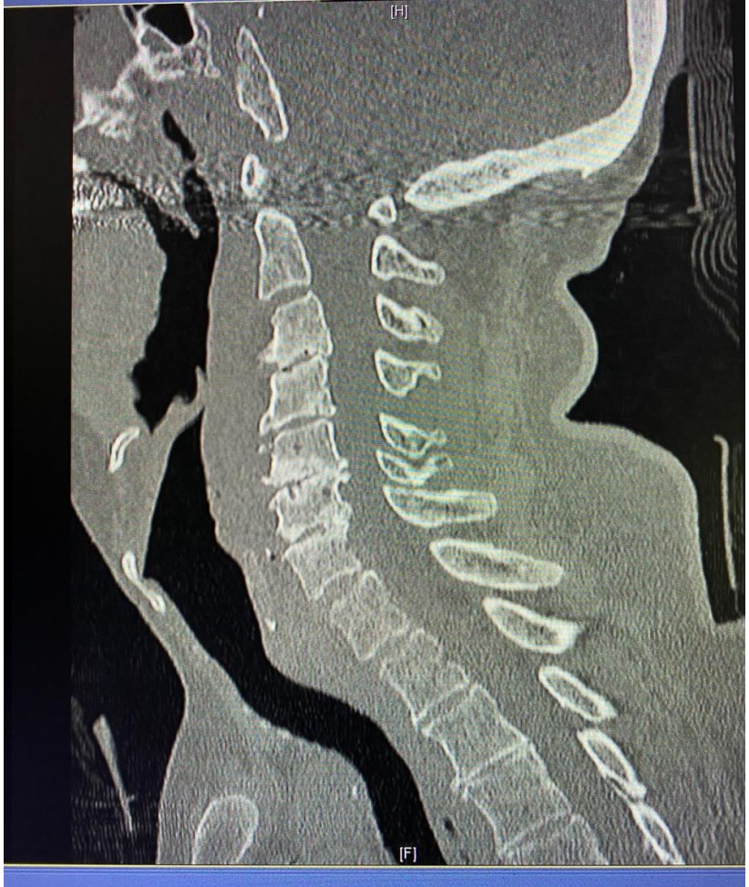 Sagittal CT cervical spine after a fall.