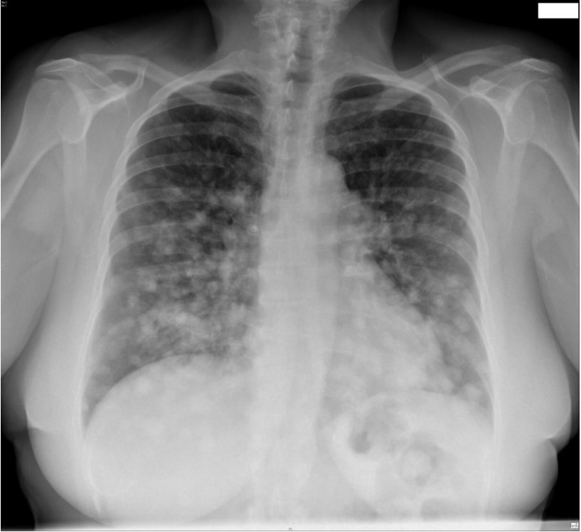 Chest x-ray in a woman with cough and haemoptysis.
