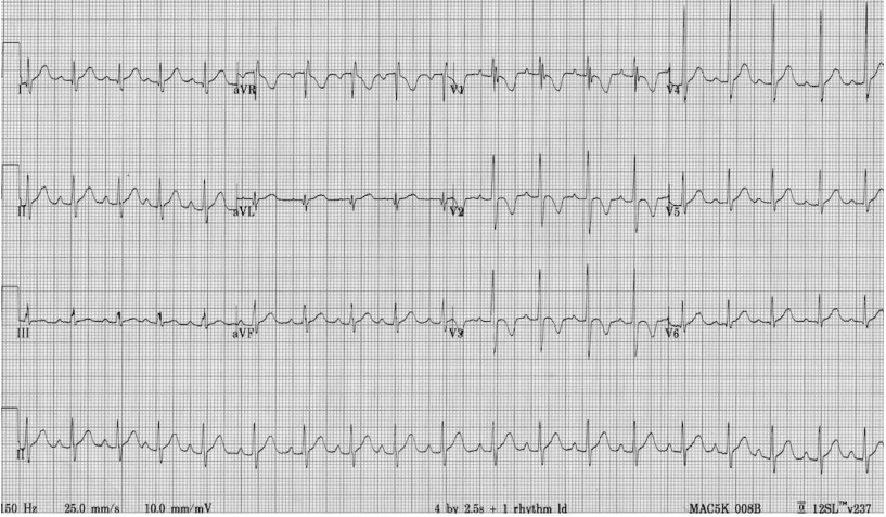 Paediatric 12-lead ECG after exertional syncope.