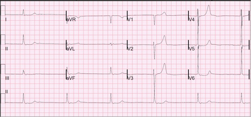 ECG showing marked bradycardia in an older woman.