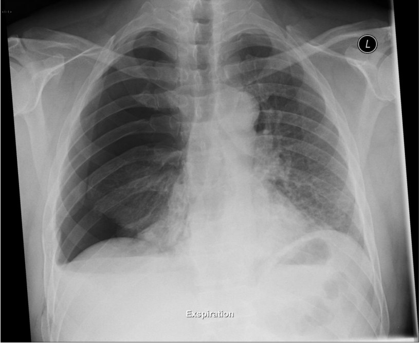 Chest x-ray after a fall with right-sided chest pain.