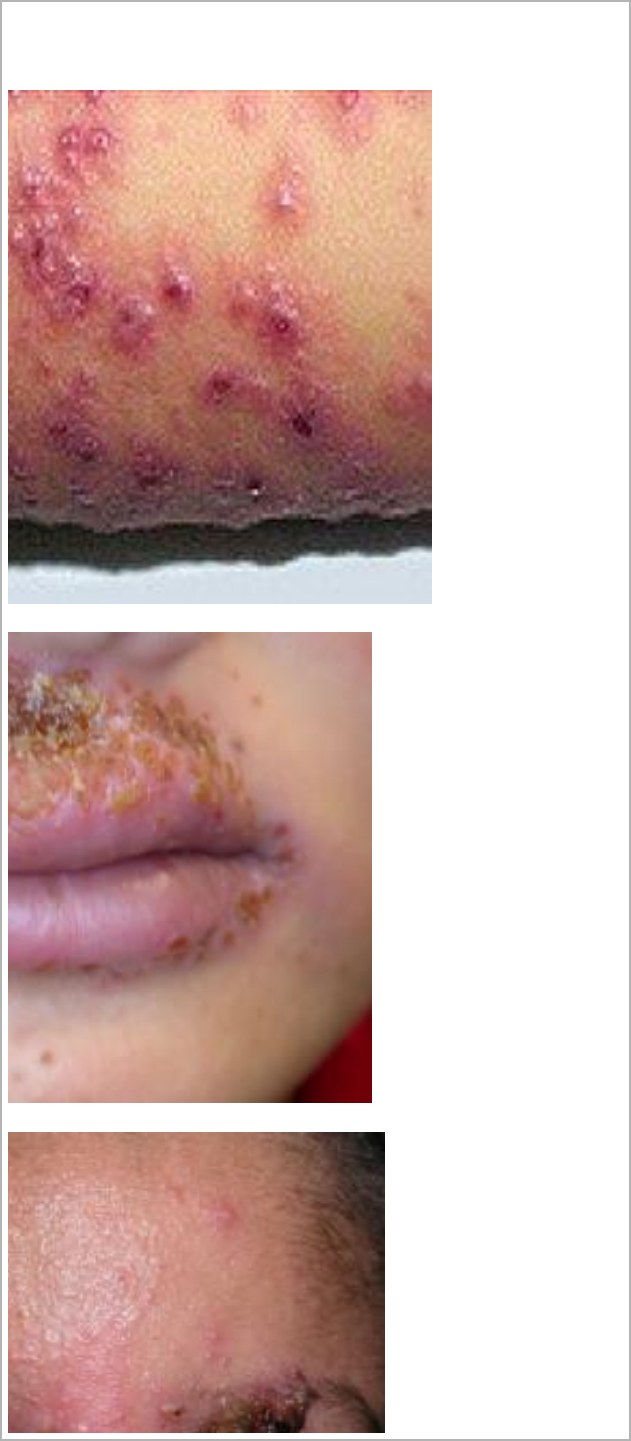 Rash photographs in a toddler with fever and eczema.