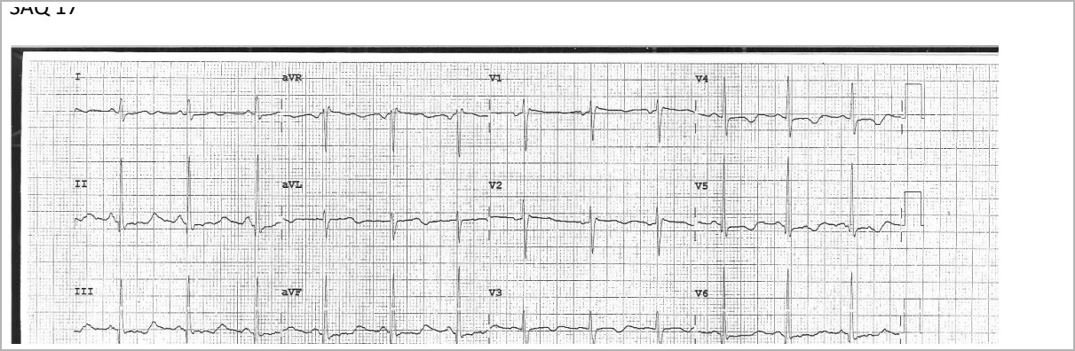 12-lead ECG after syncope.