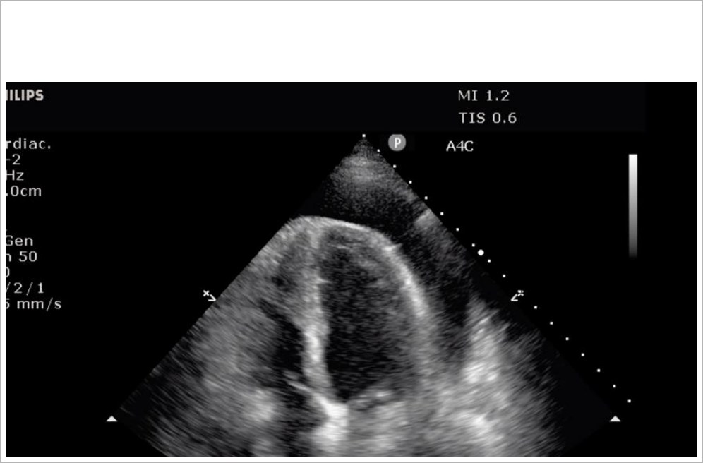 Apical cardiac POCUS image in PEA arrest.