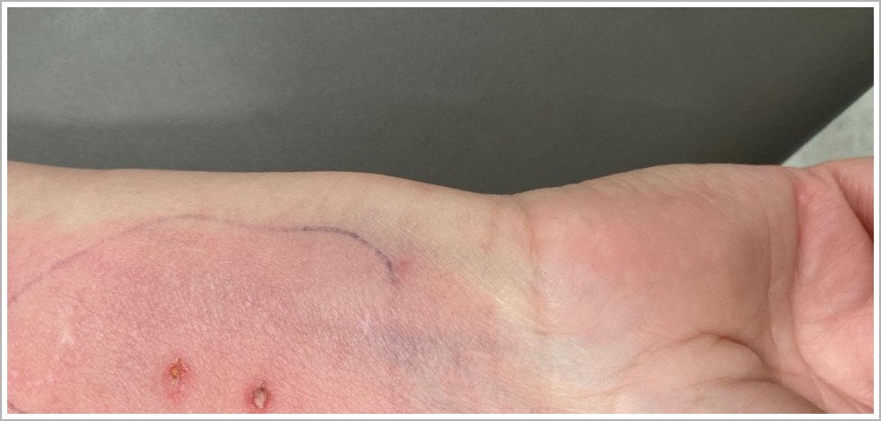 Forearm photograph after cat bite.
