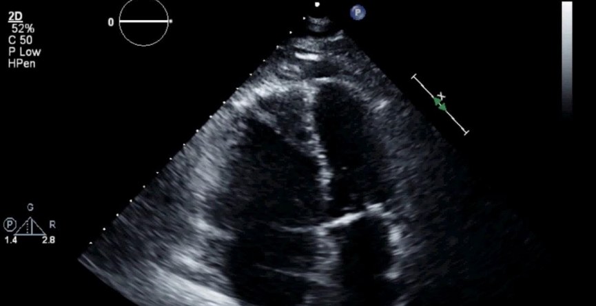Cardiac POCUS image after collapse.