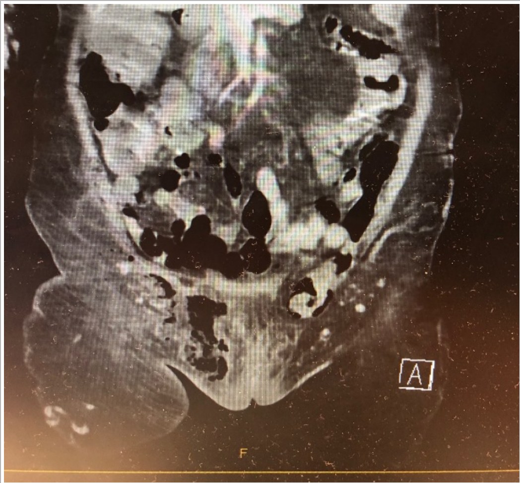 Coronal abdominal CT image.