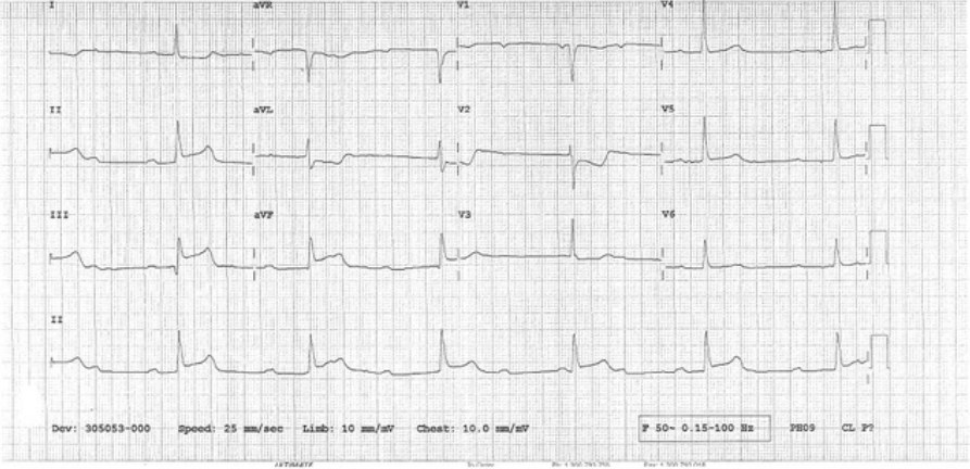 12-lead ECG after syncope.