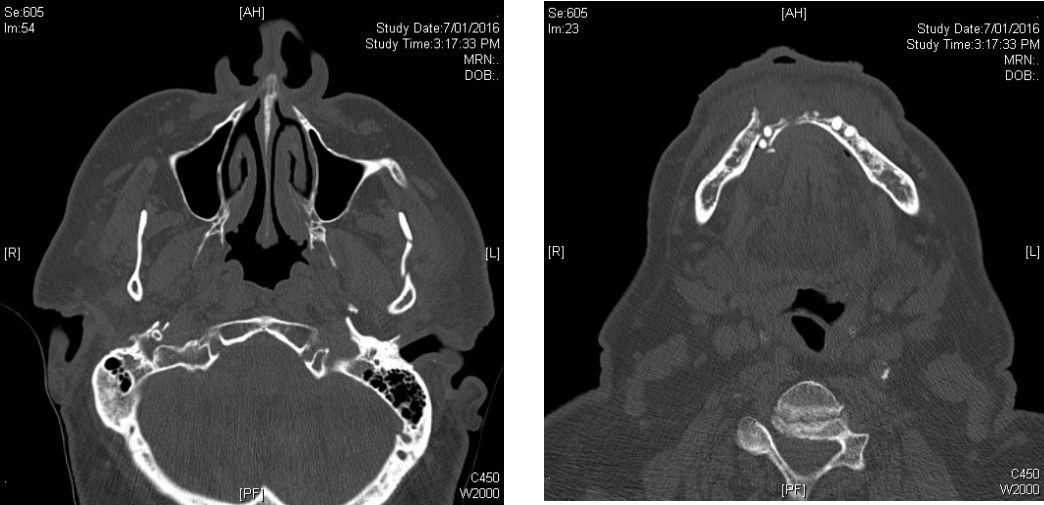 Axial facial CT images.