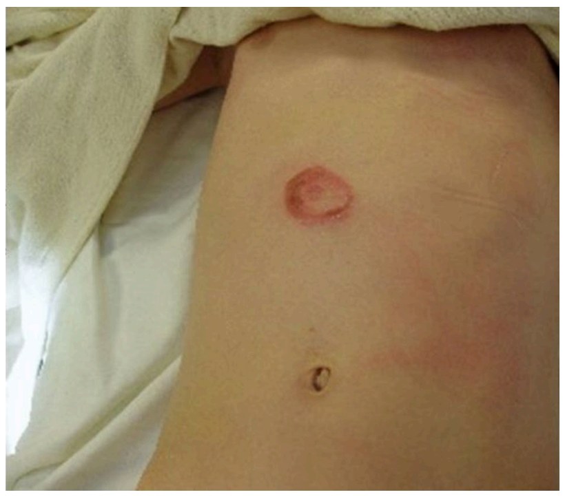 Clinical photograph of abdominal bruising after bicycle injury.