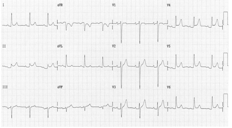 12-lead ECG for chest pain after vaccination.