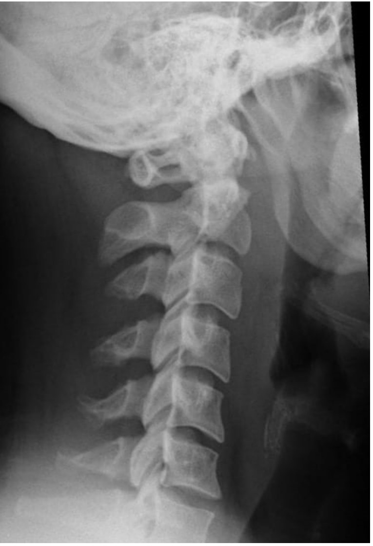 Lateral neck x-ray for severe neck pain.