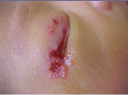 Clinical photograph of neonatal periocular vesicular rash.