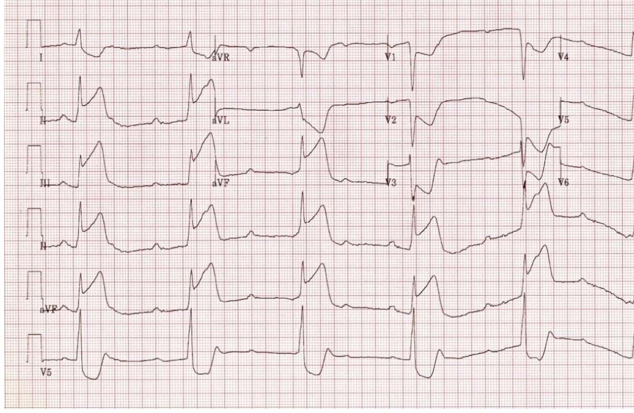 ECG after out-of-hospital cardiac arrest showing inferior STEMI with complete heart block.