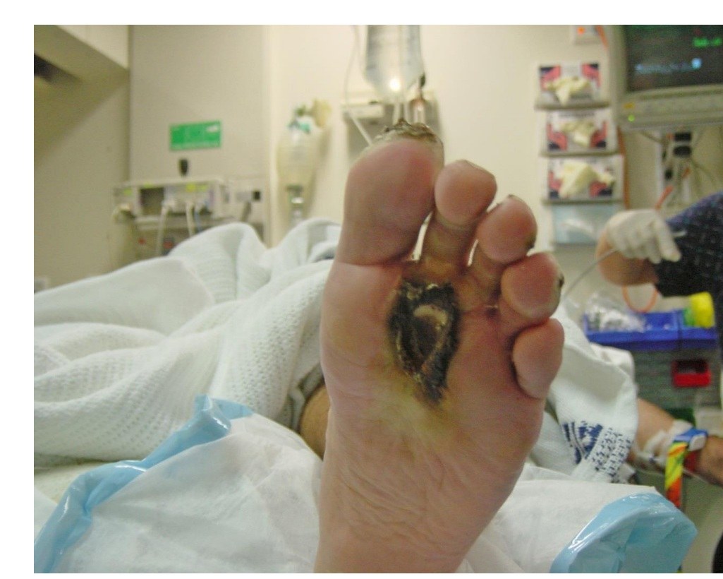 Clinical photograph of a plantar full-thickness electrical burn.