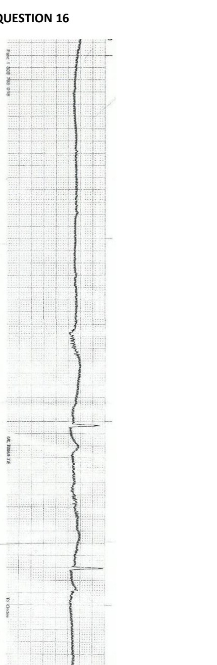 Ambulance rhythm strip in a patient with recurrent bradycardia.