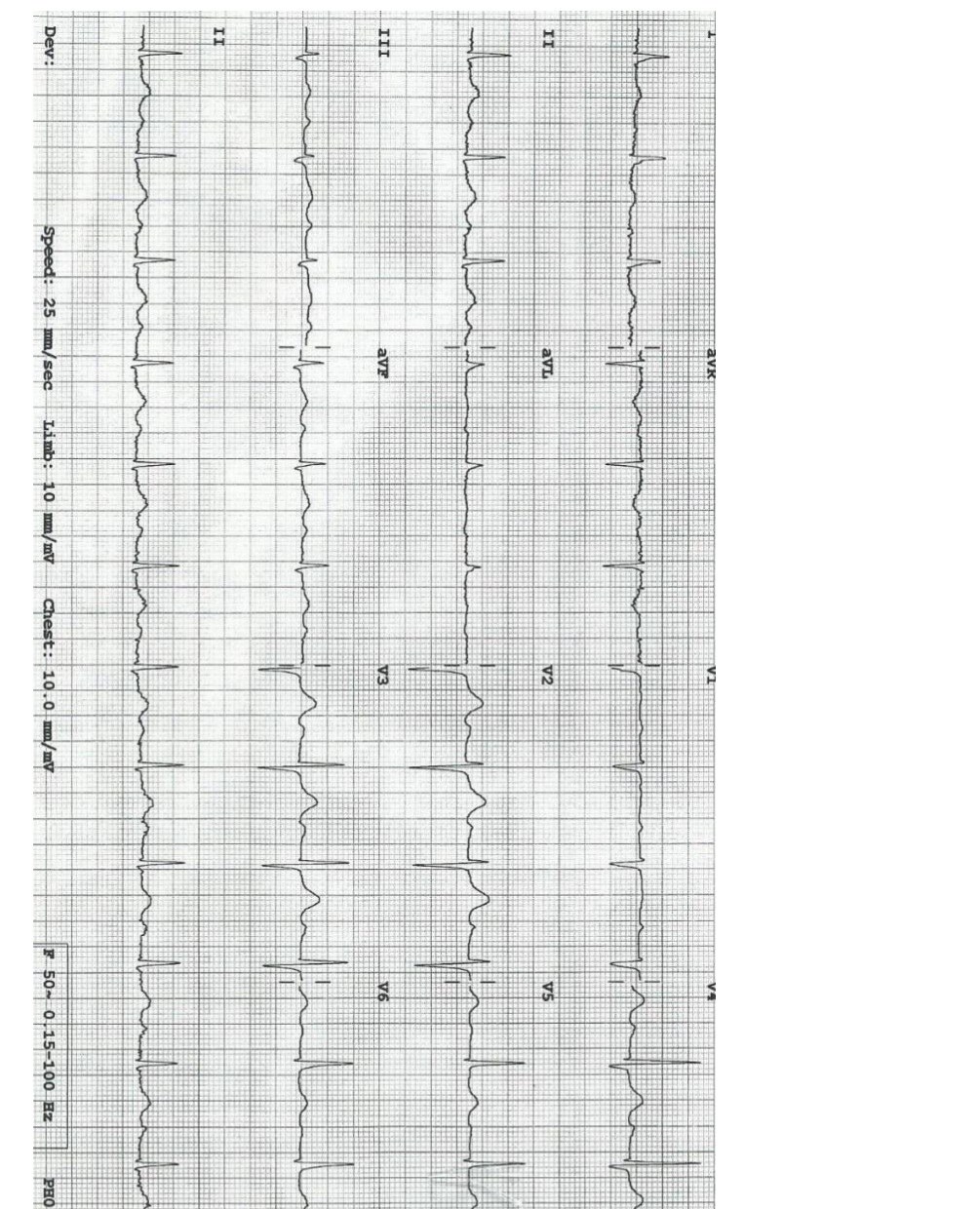 Arrival 12-lead ECG in a patient with syncope and bradycardia.