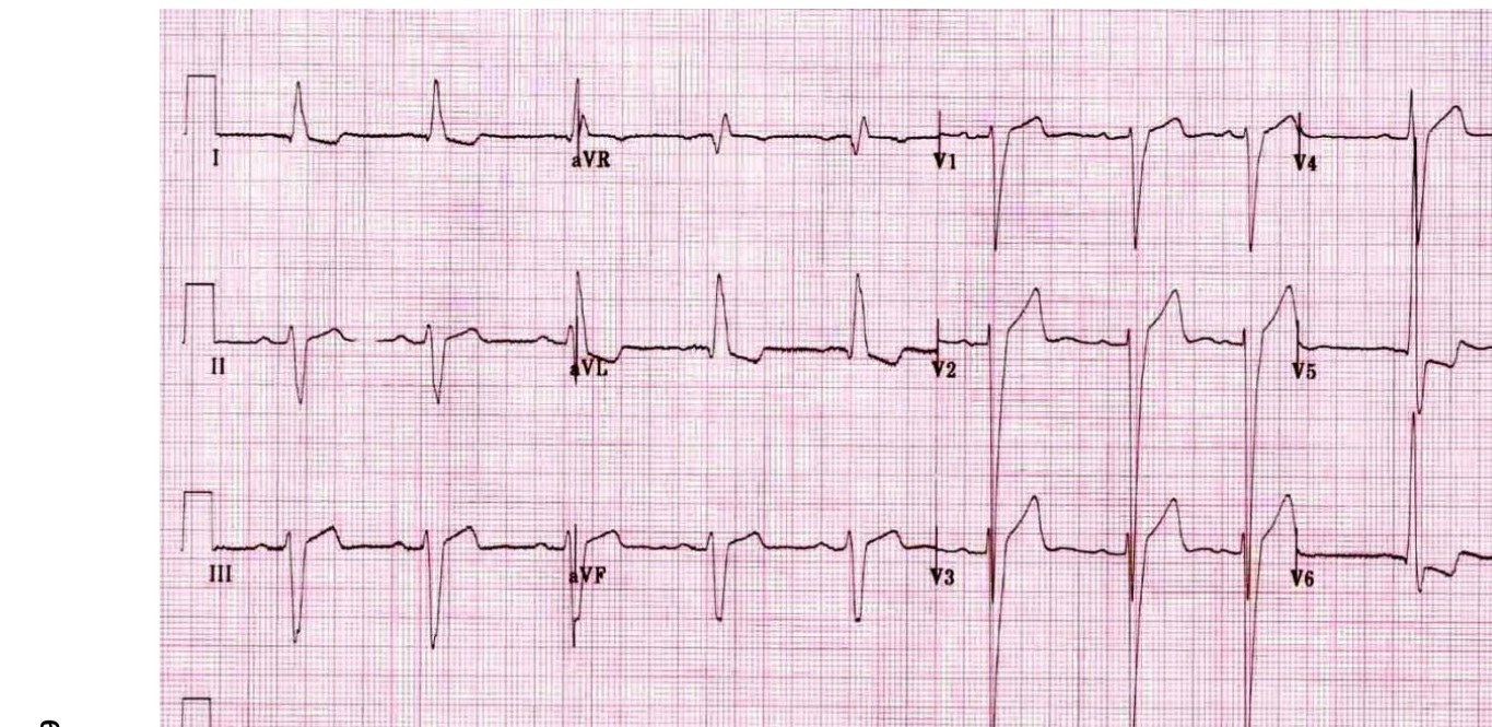 ECG showing left ventricular hypertrophy and strain pattern.