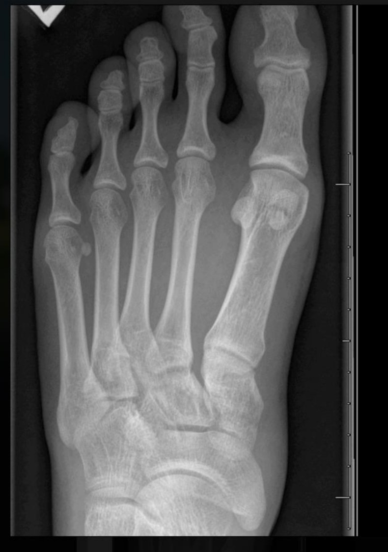 AP foot X-ray showing widening between the first and second metatarsals, consistent with a Lisfranc injury.