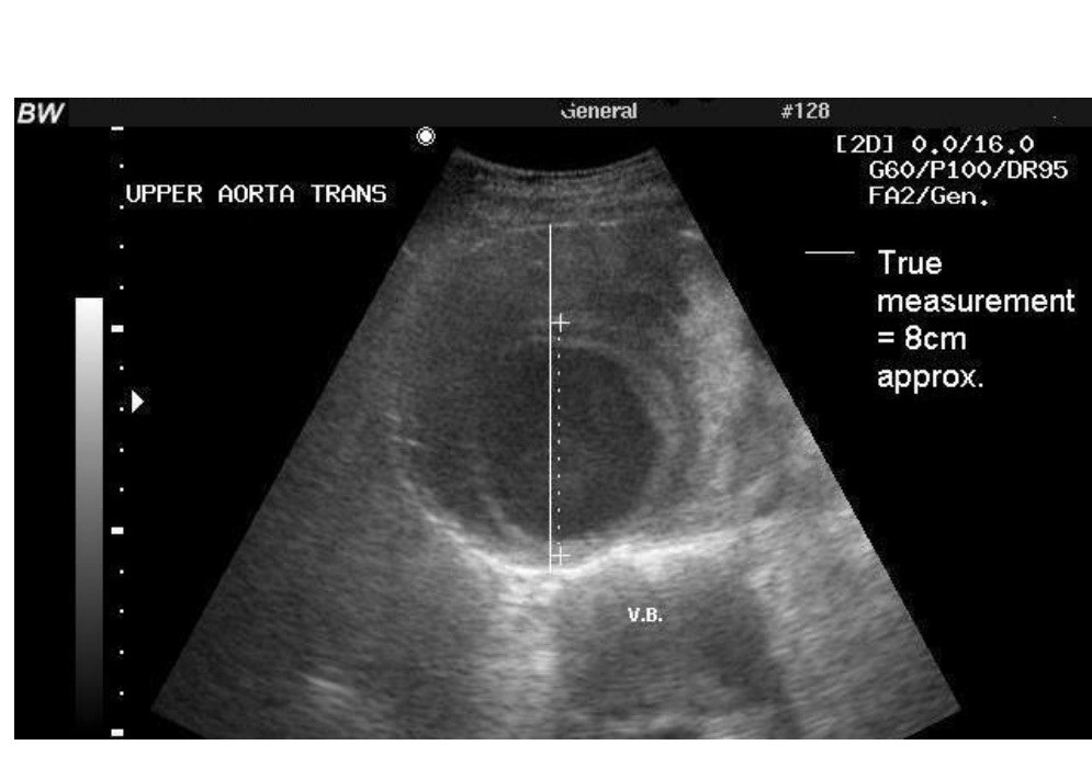 Bedside ultrasound showing an abdominal aortic aneurysm measuring approximately 8 cm.