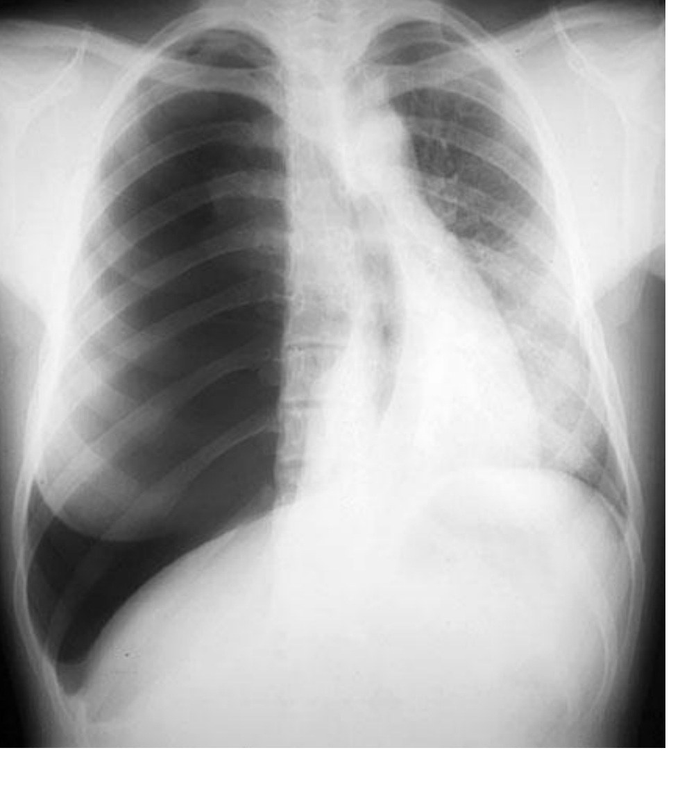 Chest X-ray showing a large right tension pneumothorax.