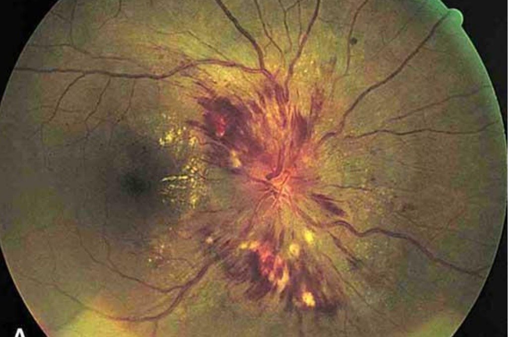 Retinal photograph showing hypertensive retinopathy changes.