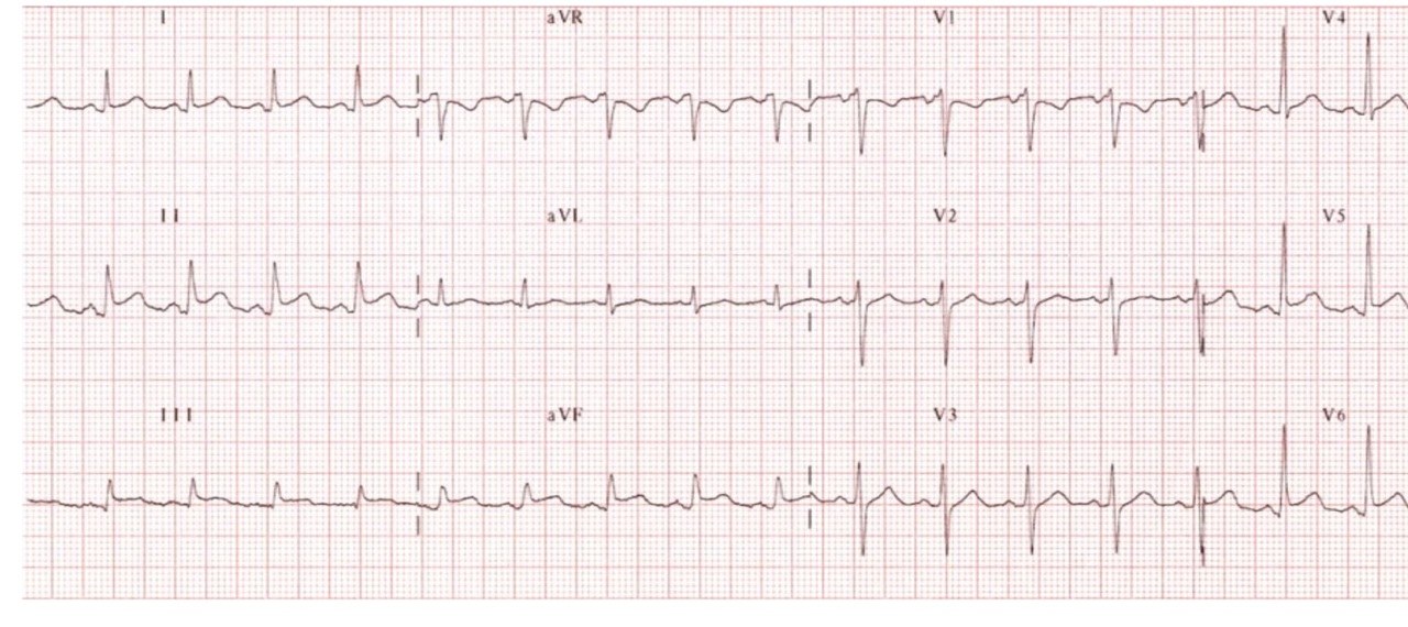 ECG for a patient with chest pain suggestive of pericarditis.
