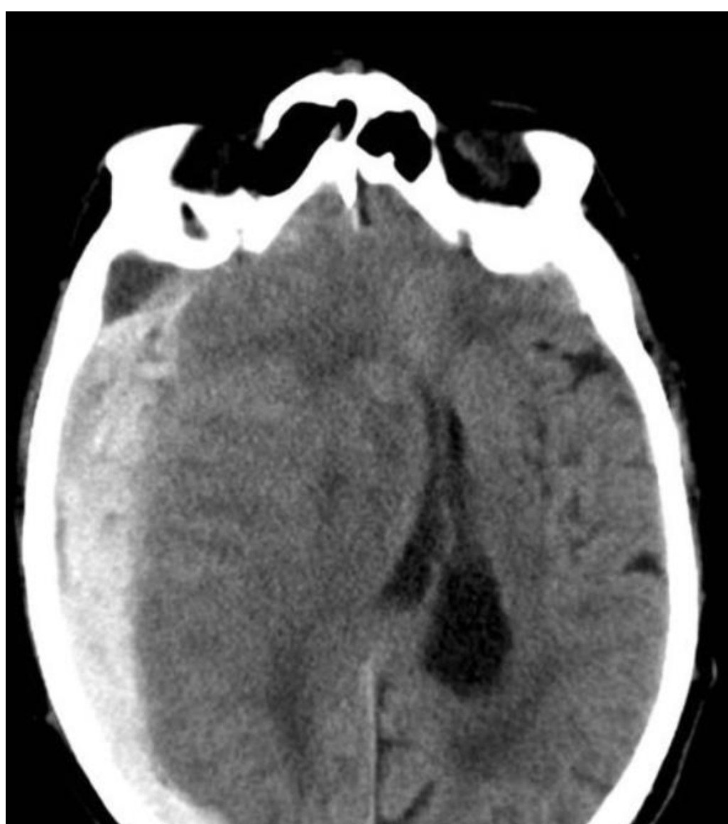 Axial CT brain slice after head injury.