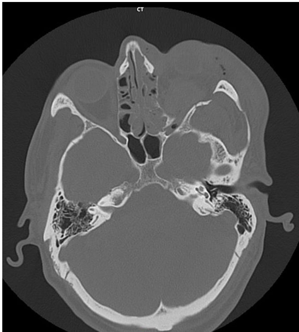 Axial CT face and orbit slice after head injury.