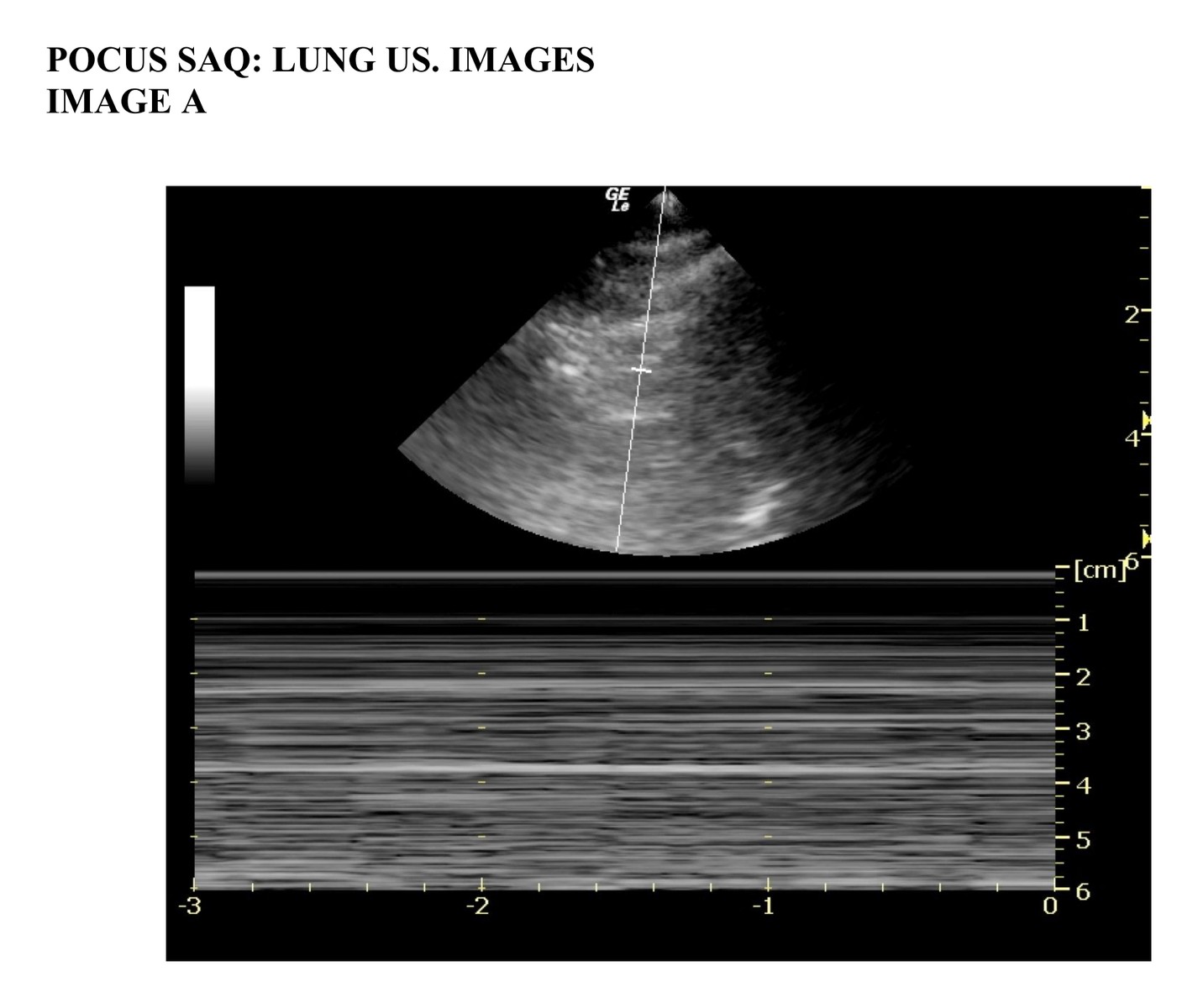 Lung ultrasound image A.