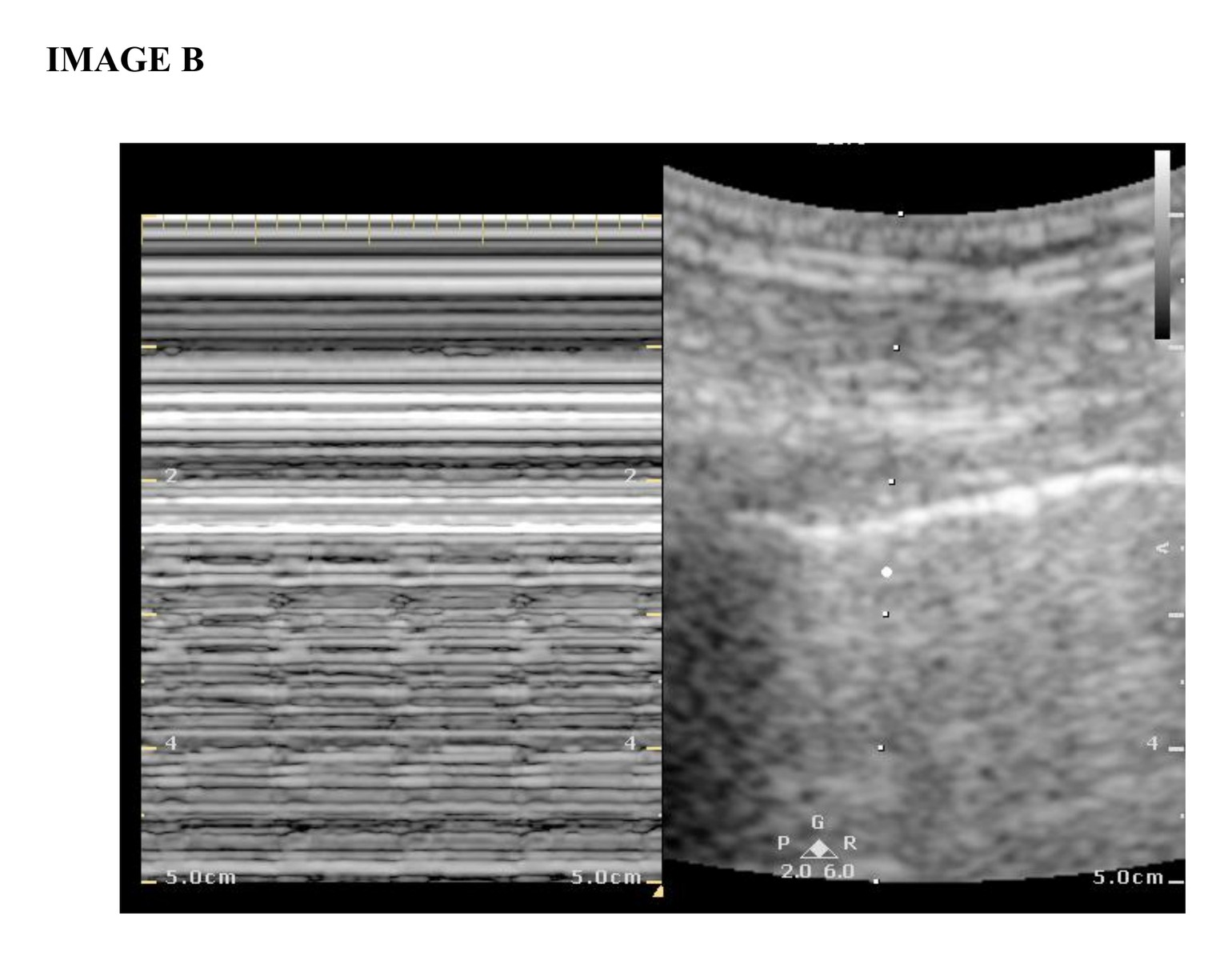 Lung ultrasound image B.