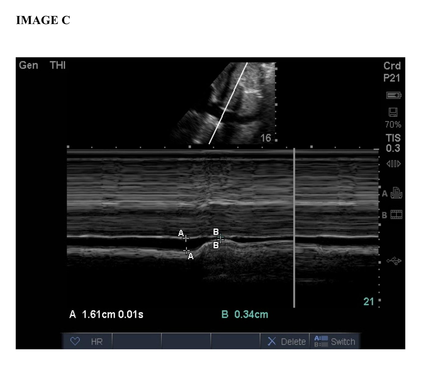 Lung ultrasound image C.