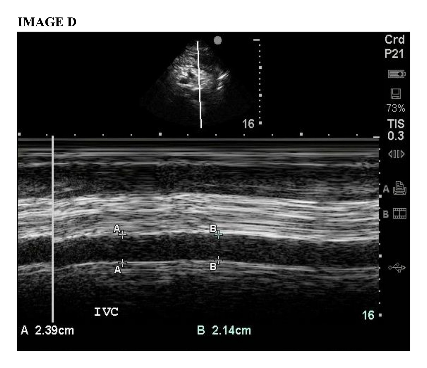 Lung ultrasound image D.