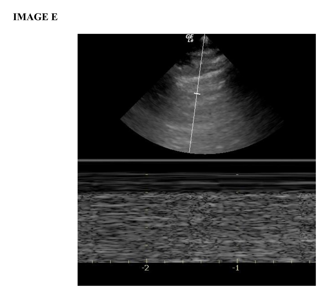 Lung ultrasound image E.