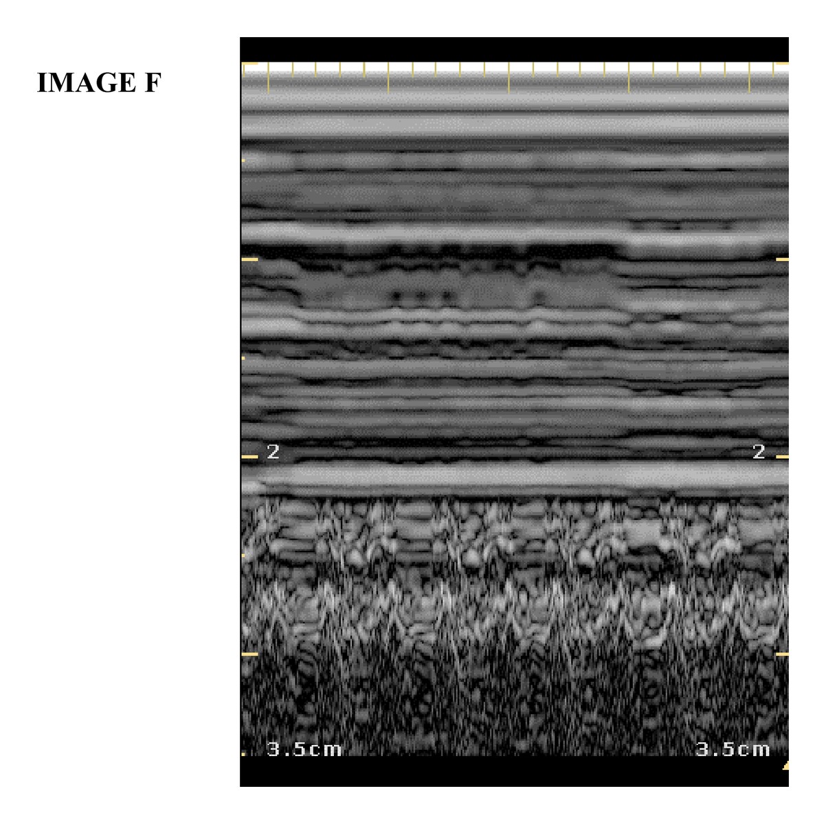 Lung ultrasound image F.