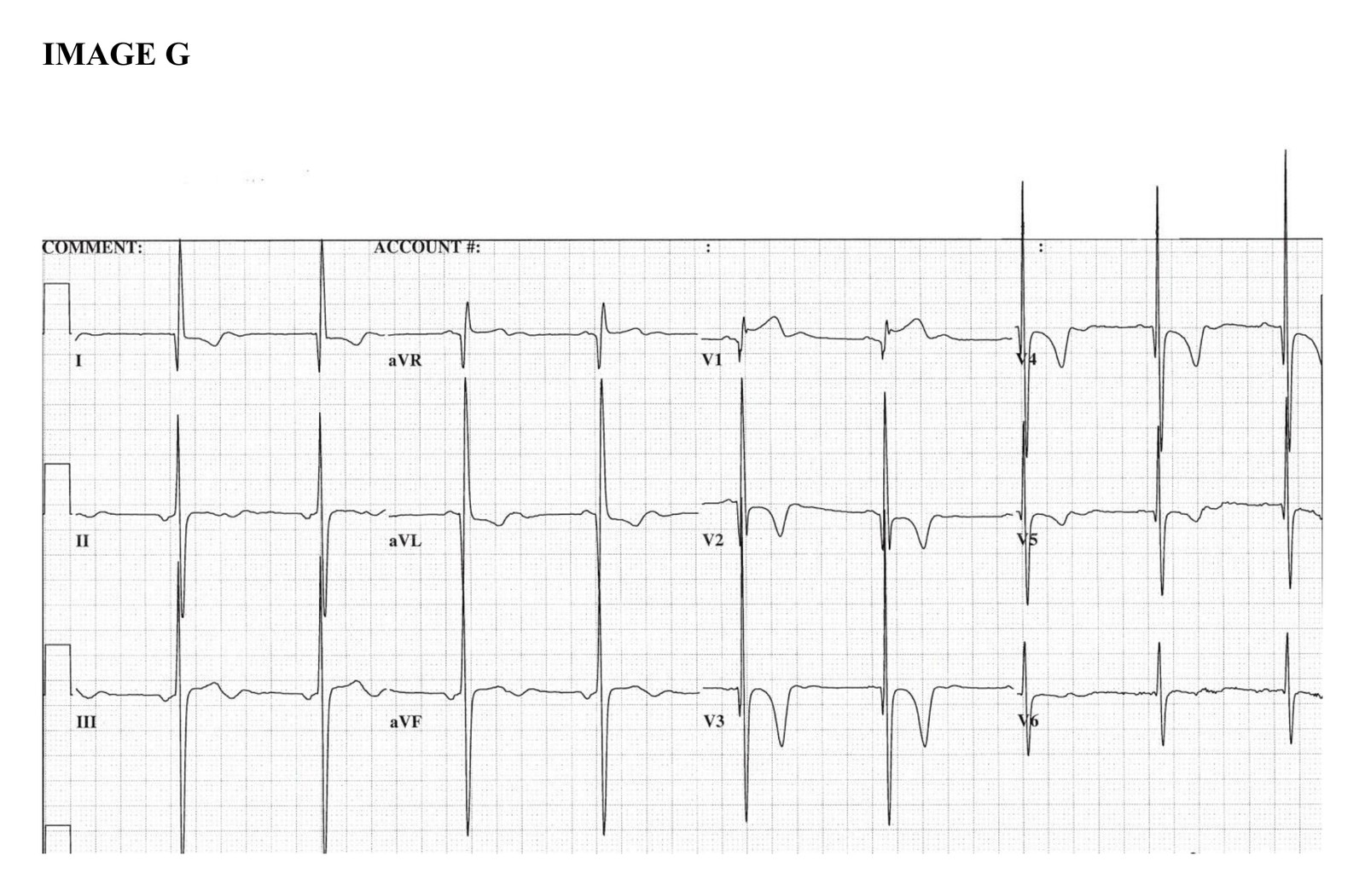 Twelve-lead ECG labelled Image G.
