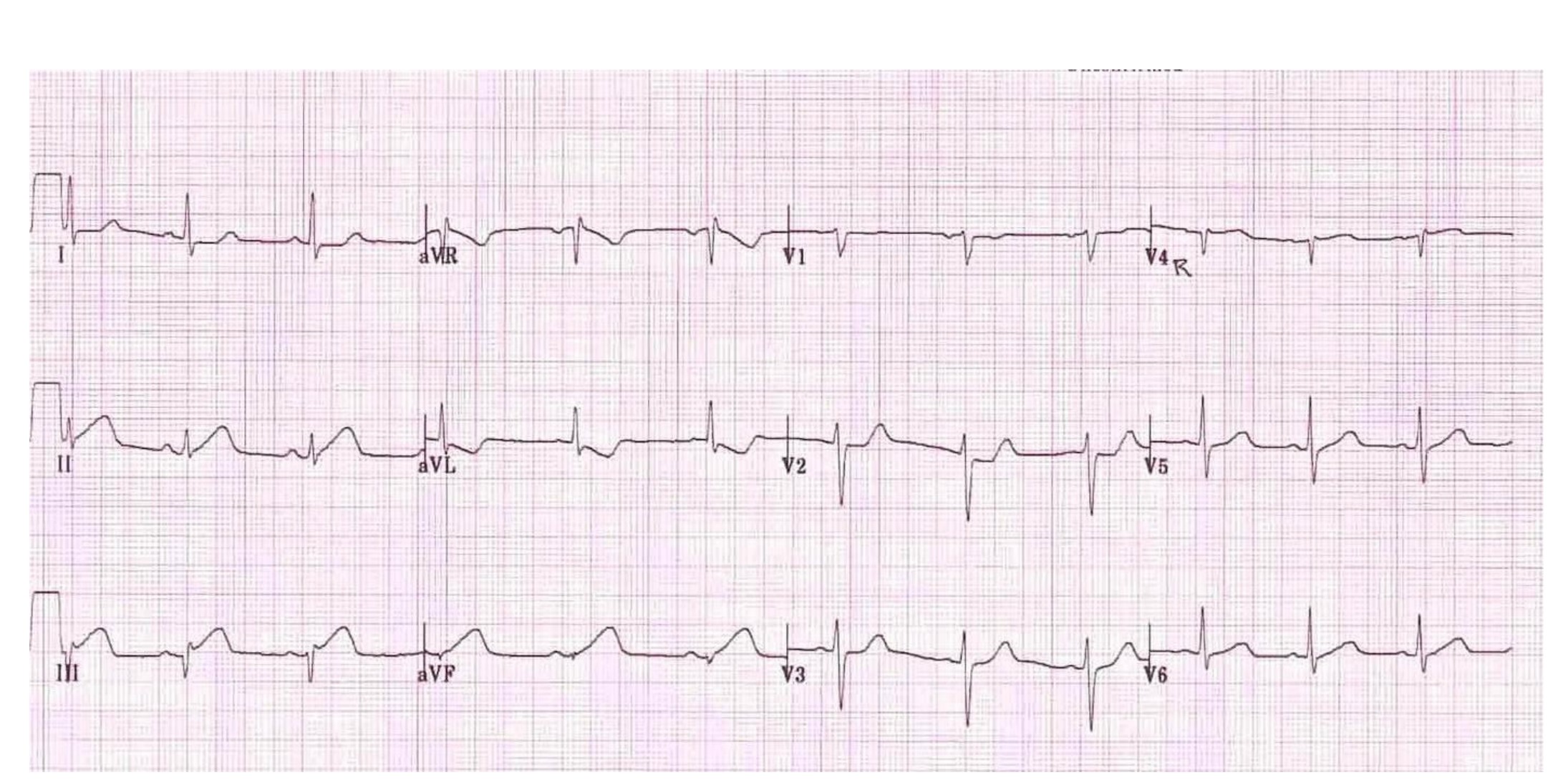Twelve-lead ECG for the acute chest pain question.