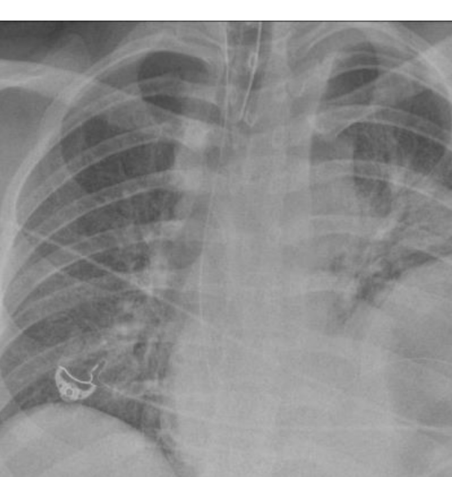 Chest X-ray after high-speed motor vehicle crash.