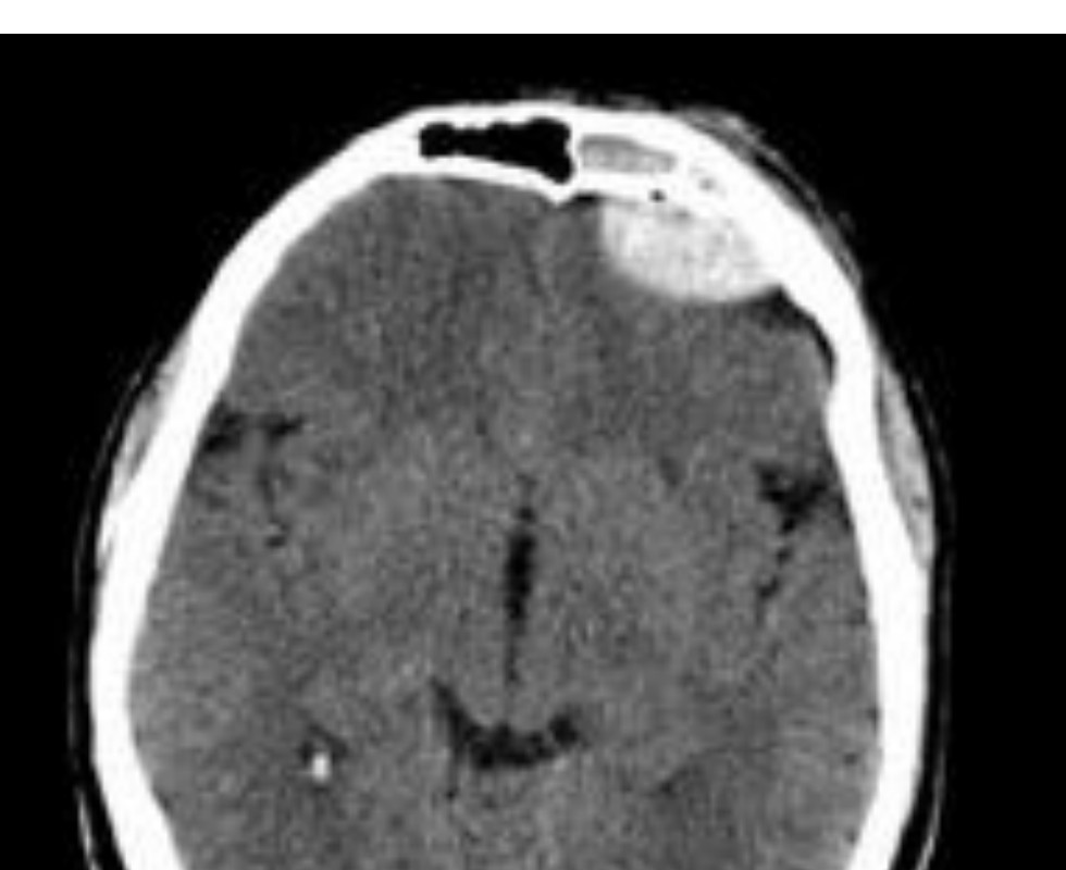 Axial CT brain image for the paediatric head injury question.