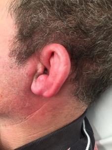 Clinical image of external ear swelling and erythema.