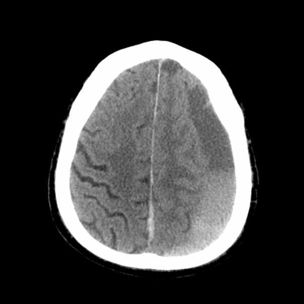 CT brain image for the fall on anticoagulants question.