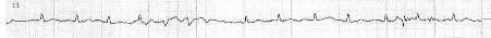 Post-cardioversion rhythm strip.